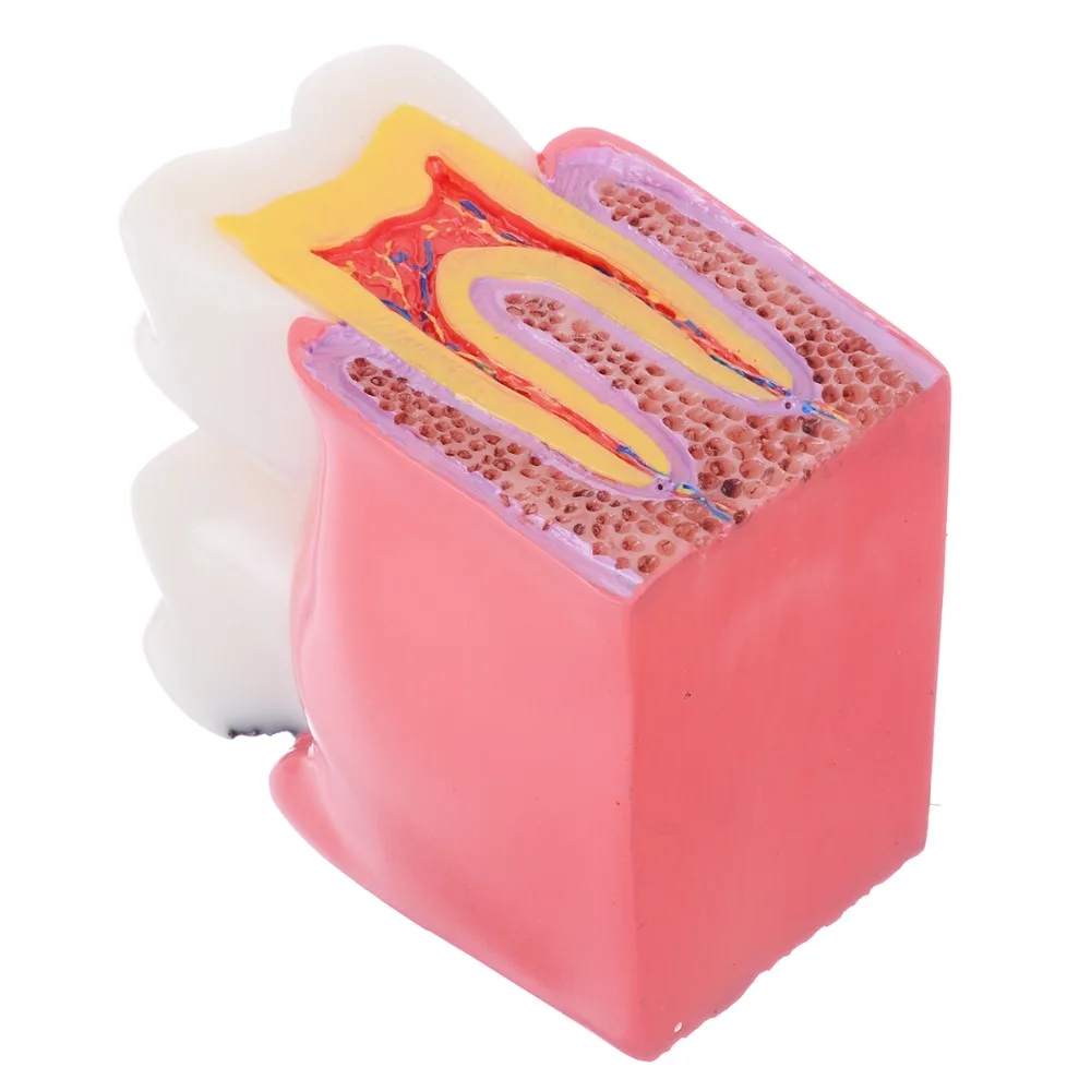 Kopen 1pc Dental Anatomie Onderwijs Tanden Model 6 Keer Cariës Comparation Studie Modellen Voor Tandarts Studeren en Onderzoek
