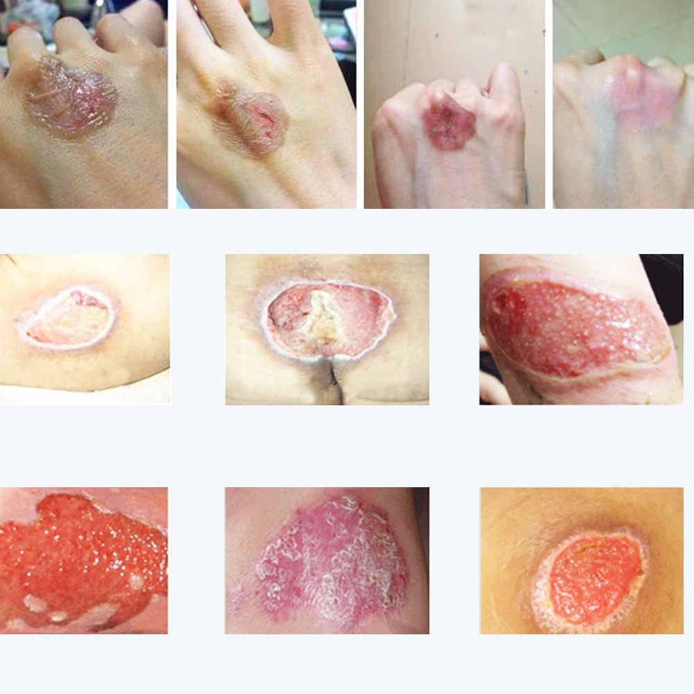 Заживляющая кожу мазь, крем для ран пролежни паста лечение пролежней под давлением/пролежней/давление заживление ран D075
