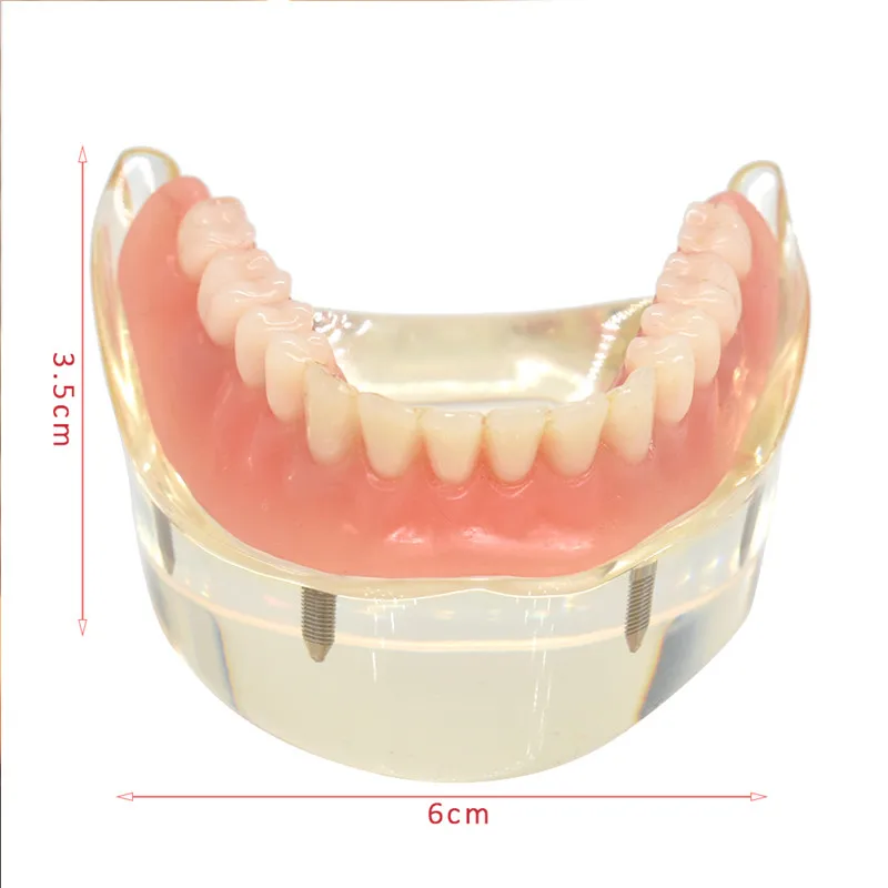 Mandibulares com Implante de Dente Modelo Teeth Dental Overdenture Removível Interior Mandibular Inferior Estudo Ensino Modelo Dentes 17 Modelo de Ensino Dental