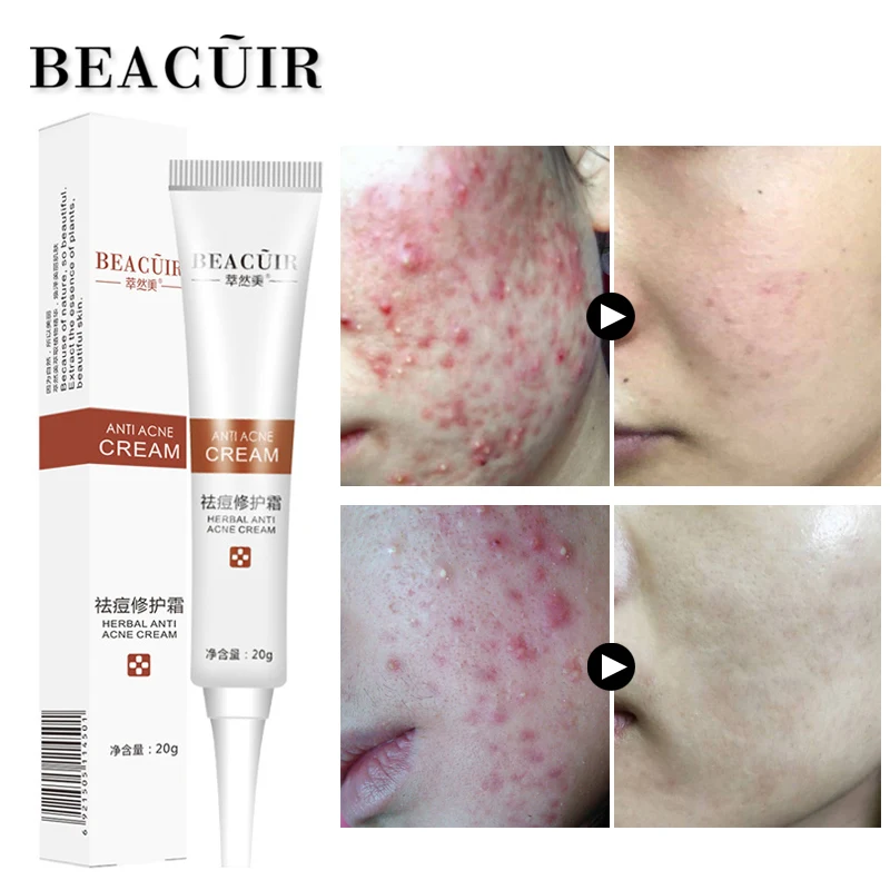BEACUIR Rejuvenation Acne Cream Anti Treatment Scar Removal Whitening Moisturizing Shrink Pores Beauty For Face Skin 20g | Красота и