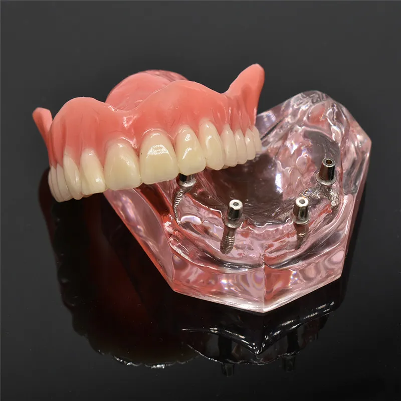 Skup Dental Overdenture model zębów zdejmowane wnętrze żuchwy dolny model zębów żuchwy z implantem do nauczania zębów