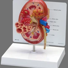 Патологическая модель моделей заболеваний почек, модели камней почек, двусторонний, нормальный и патологический дисплей анатомии