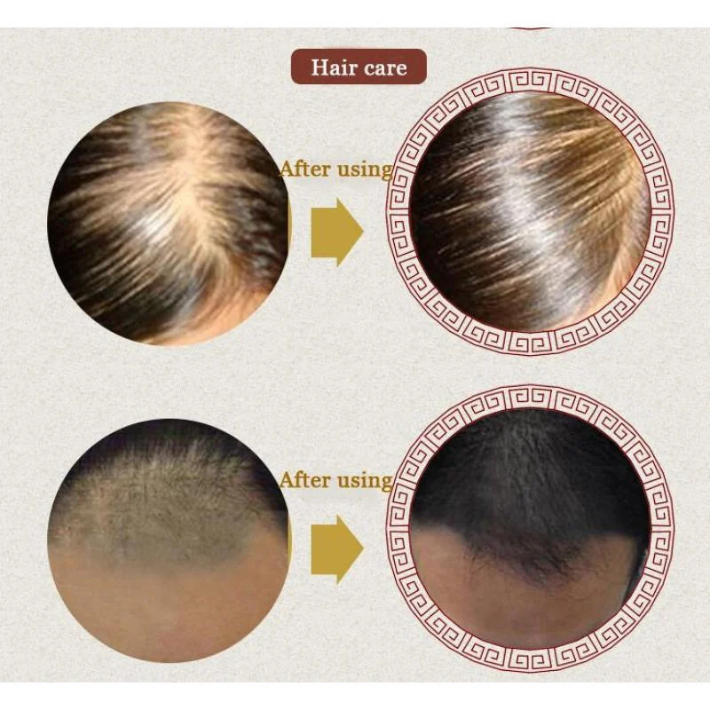 Уход за волосами для роста волос Эфирные масла эссенция подлинный выпадения волос жидкость для здоровья красивые, густые сыворотки полезные