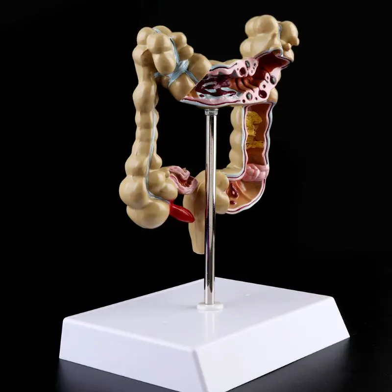 Человека, модель поражения патологическая анатомия Колон заболеваний кишки для медицинской учебной обучающий инструмент