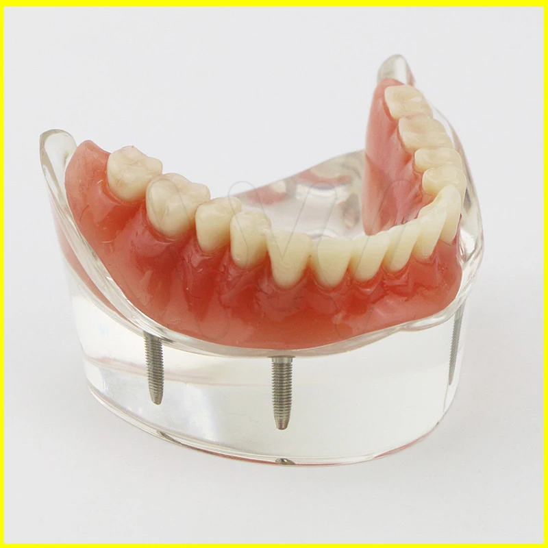 1 шт. Стоматологическая модель исследования зубов Overdenture уст 4 имплантата демонстрационная модель
