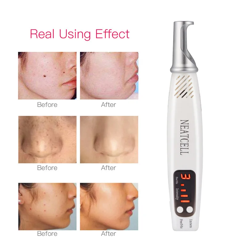 

Professional Handheld Laser Picosecond Pen Eyebrow Tattoo Mole Removal Machine Beauty Device Deep Face Cleanser Skin Care 45