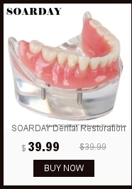 SOARDAY Overdenture низкого качества с 4 импланты с шероховатой поверхностью стоматологический для обучения зуб зубы стоматолог стоматология зубные полоски