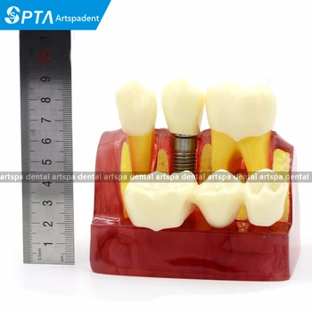

IMPLANT MODEL CROWN BRIDGE DEMOSTRATATION TEETH TOOH TYPODONT DENTOFORM