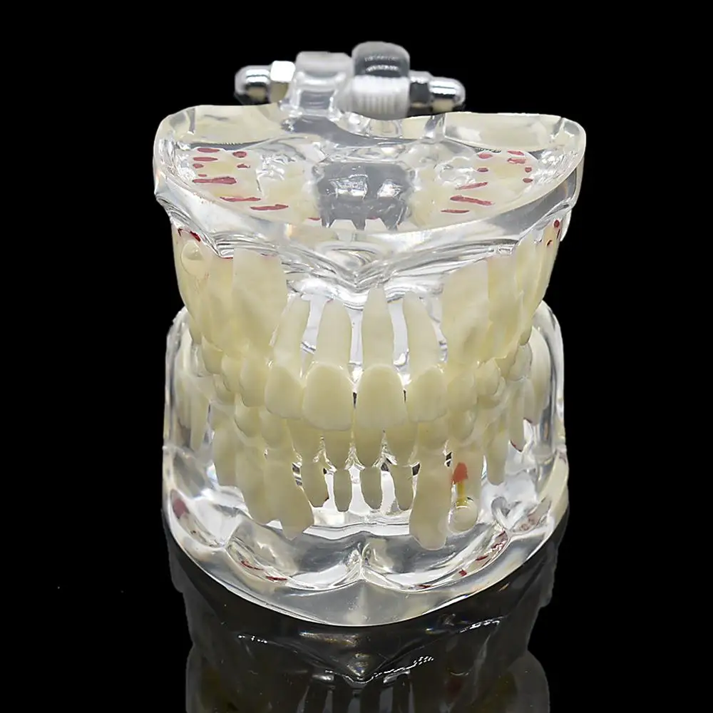 Стоматологическая детская патологическая медицинская стоматологическая модель зубов патологическая модель Стоматологический материал стоматологические инструменты Стоматологическая лабораторная модель