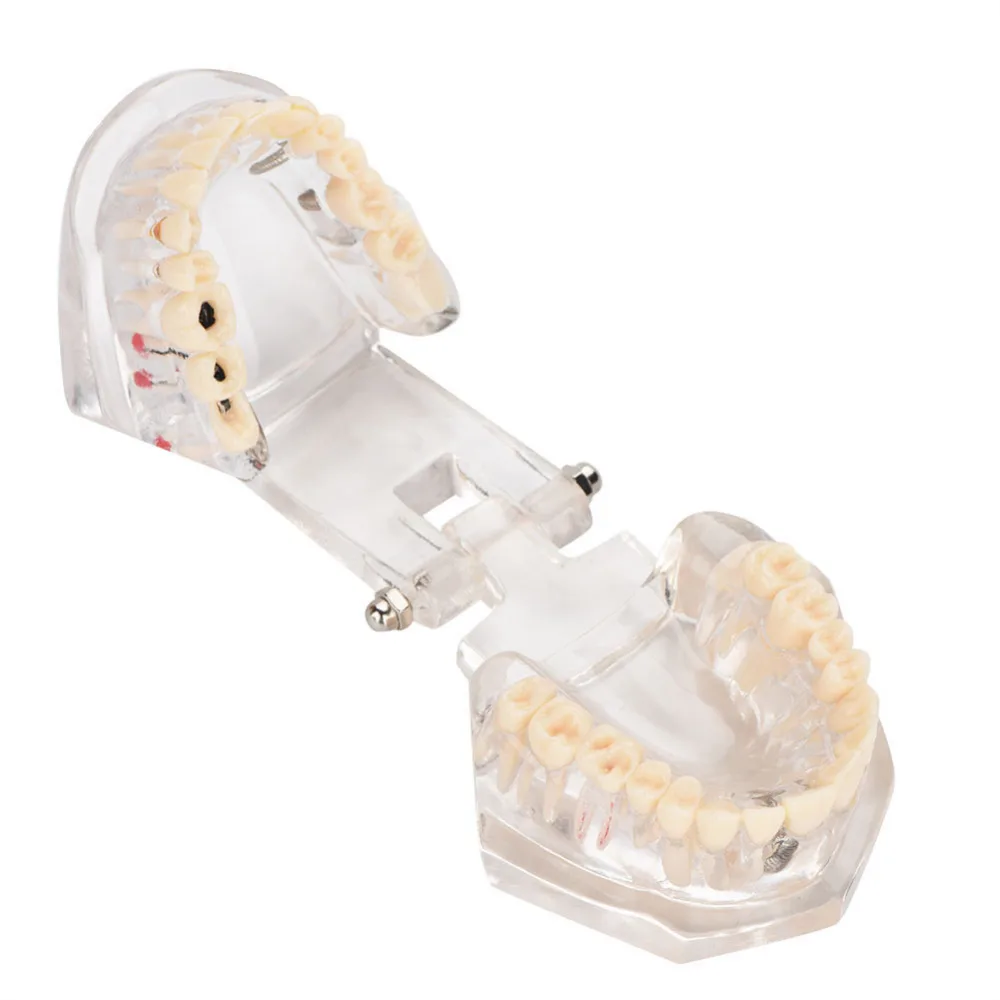 1 шт. Смола Комплексная Стоматологическая практика обучающая модель зубы модели прозрачный нерв съемный молярный зуб для всех возрастов