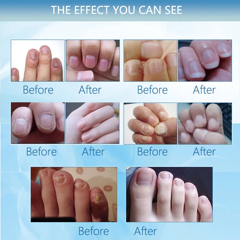 Professional Herb Nail Antibacterial Oil Nail Repair Nourishment Antifungal Brightening Toe Finger Fungus Removal Nail Care Oil