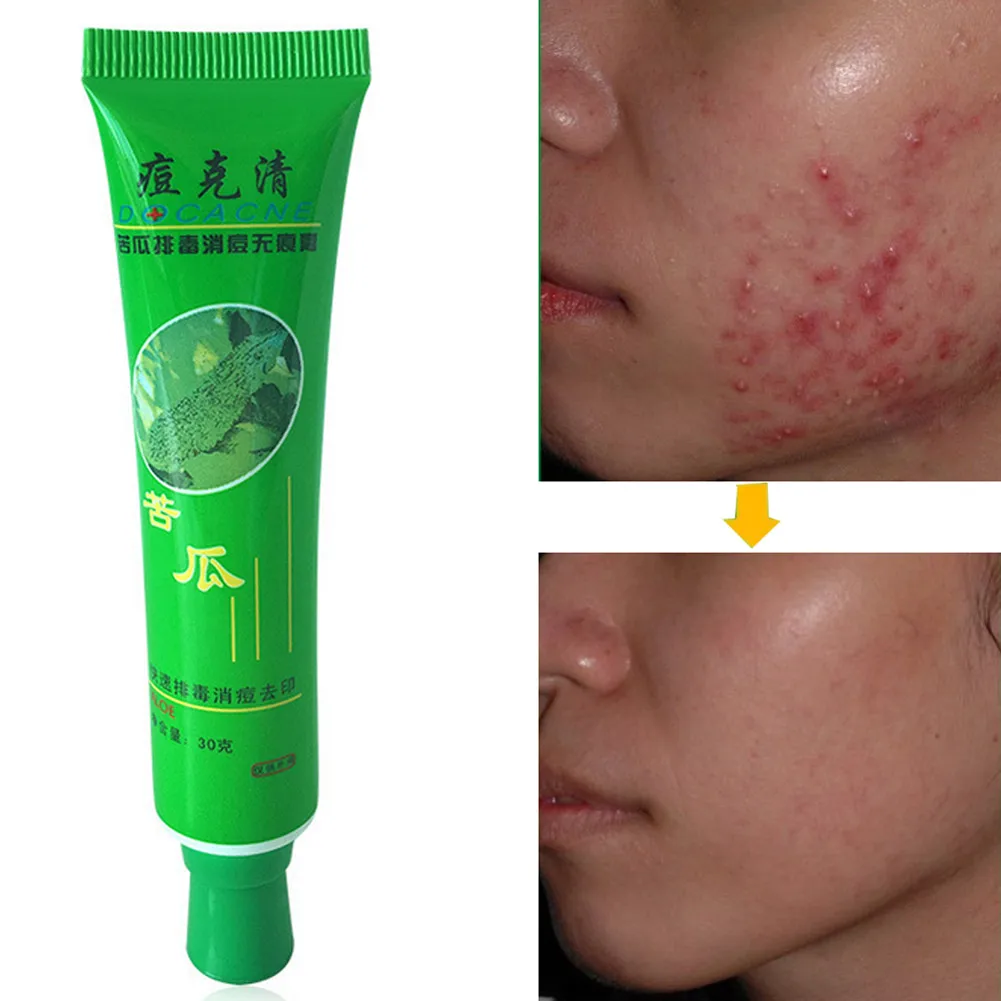 30 г крем для лица Красота код кожи лица ремонт акне крем масло Управление Acne Remover Уход за кожей лица @ ME88