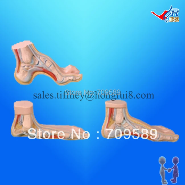 

ISO Arched Foot, Flat Foot and Normal Foot Model, Anatomical Foot Model