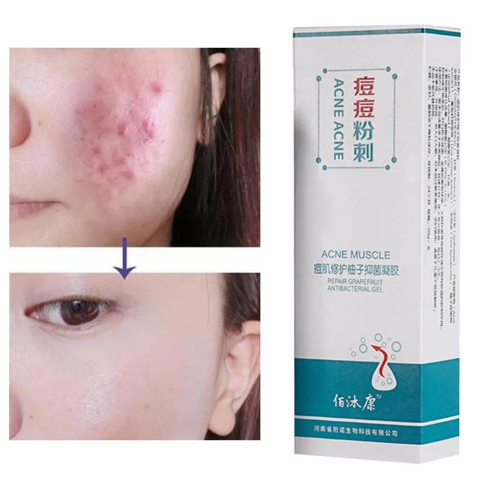 

Acne Printing Repair Grapefruit Antibacterial Gel Acne Ointment to Eliminate Acne Marks Stubborn Acne Removal Free Shiping
