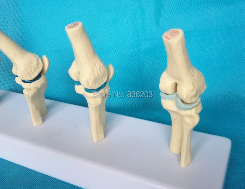 4 стадии анатомический человек дегенеративный коленный сустав Скелетон череп