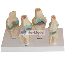 Heymodel коленного сустава болезни модель