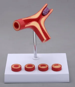 

Anatomical odontologiaHuman Anatomical Vascular Atherosclerosis Pathology Medical skull anatomical Teach Model skeleton for sale