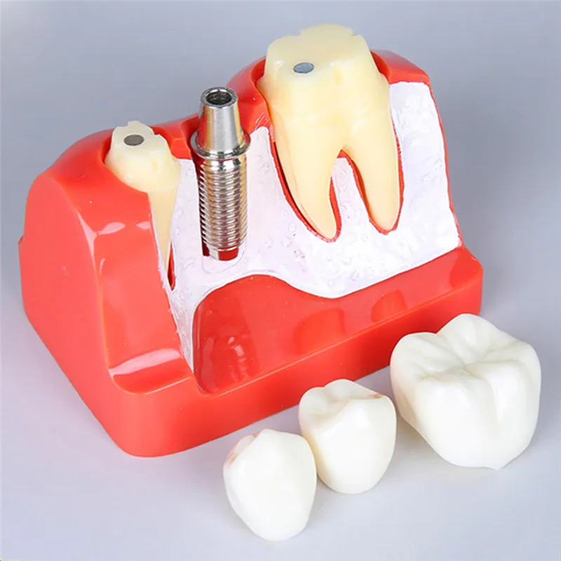 Зубной Имплантат модель зубов с винтом съемный 4 раза Зубы Модель магнит имплантат анализ Корона мост Стоматологическая обучающая модель