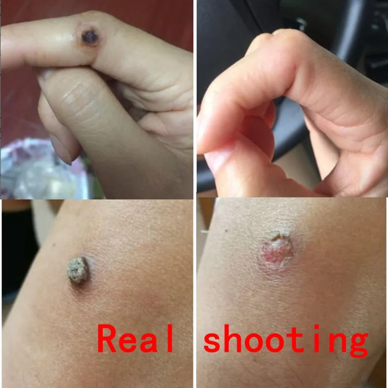 

Skin Care Removing Wart Corns Wart Removal Beauty Care Corn Remover Warts Thorn Plaster Patch Feet Callus Removal Tool Skin Tags