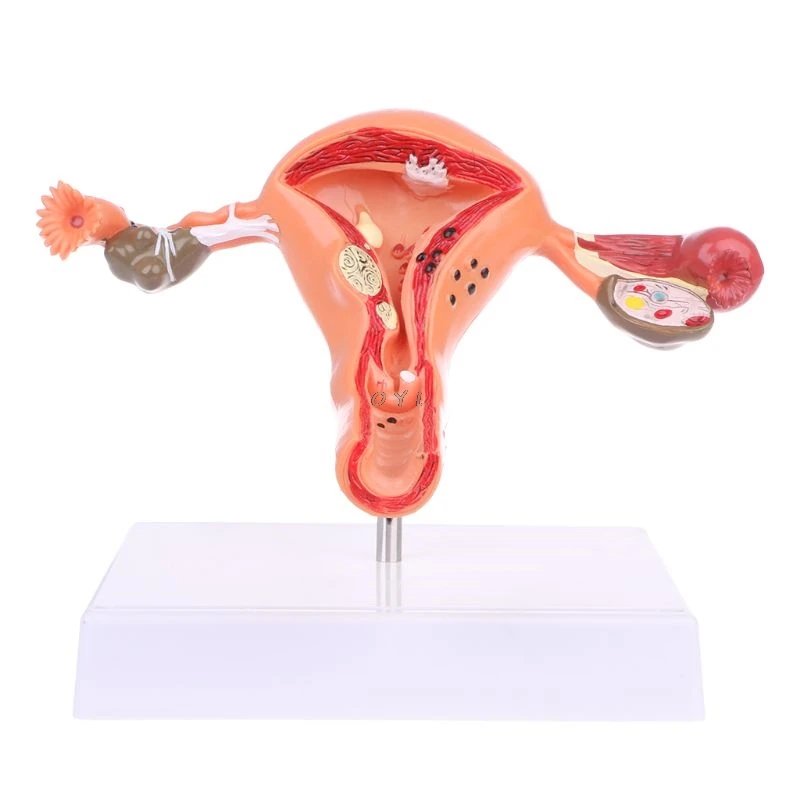

PVC Pathological Uterus Ovary Anatomical Model Anatomy Cross Section Study Tool