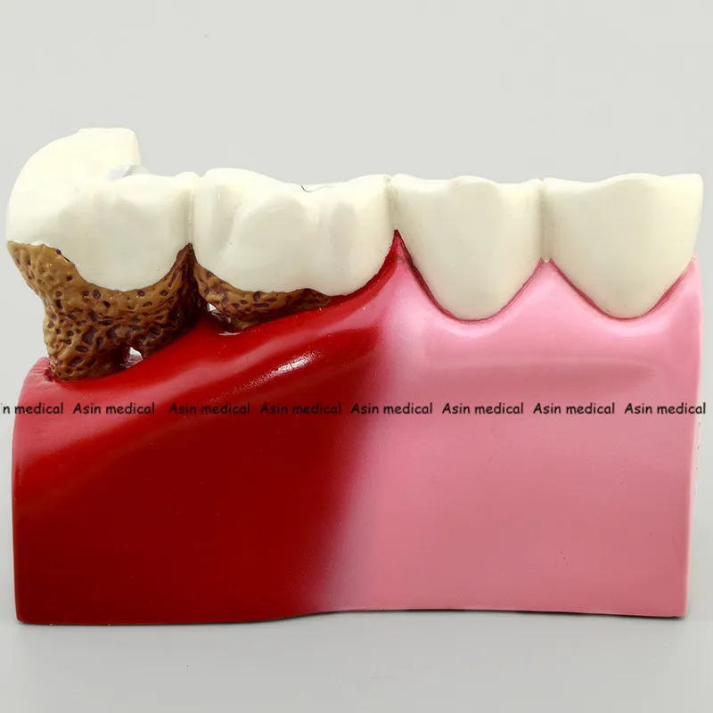 Высокое качество кариес Зуб модель стоматолога пациента связь Анатомия Модель Стоматология Богатые детали обучающие средства оборудования