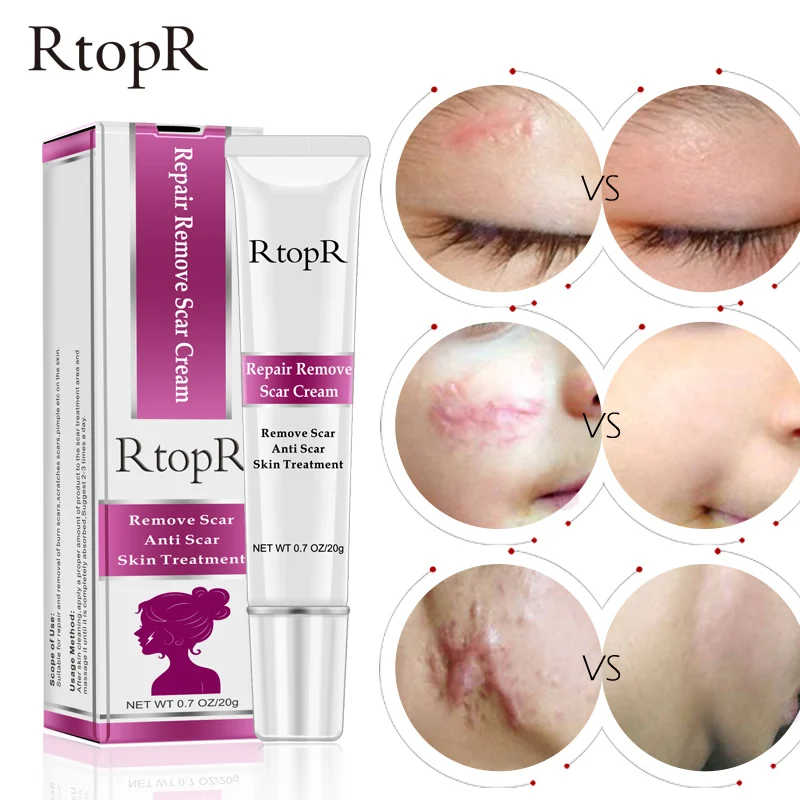 cream to remove scars