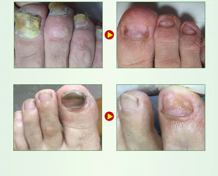 Спрей для лечения Ногтей 4 мл Onychomycosis Paronychia против грибковой инфекции ногтей Китайский Травяной Уход за ногтями