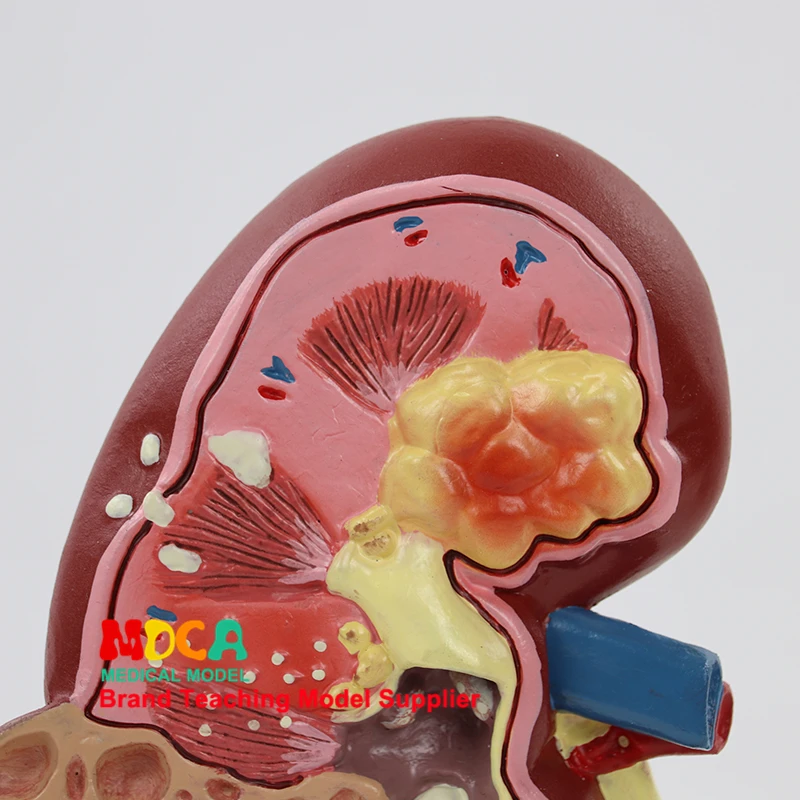 Медицинское обучение мочевой системы и почечной структуры для естественной большой модели почек в урологии человека MSZ001
