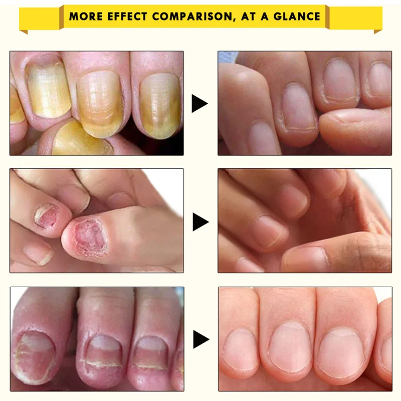 Ginseng Antibacterial Nail Treatments Essential Oil Nails Fungus Repair Foot Nail Care SK88