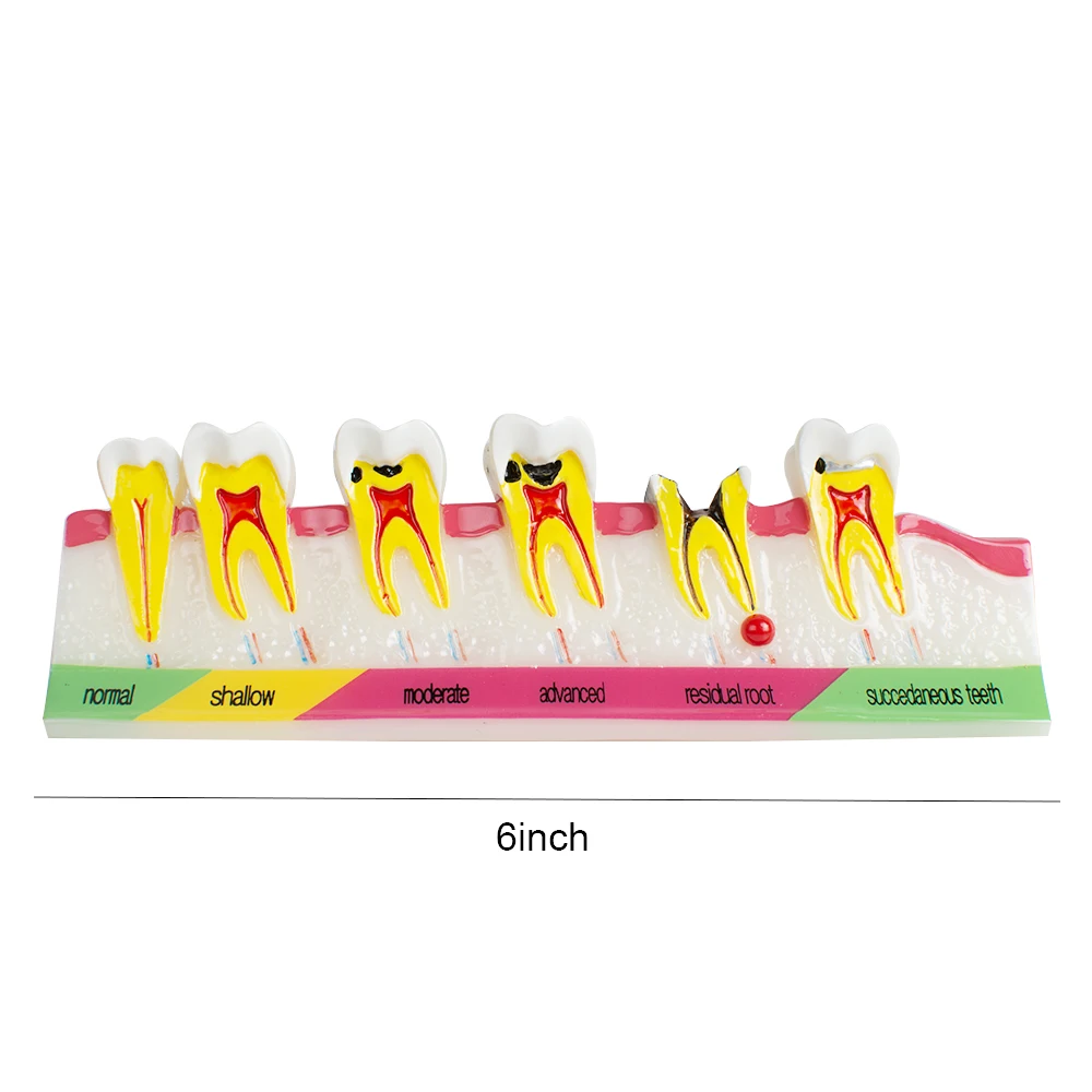 

Orthodontic Braces ,Dental Model Periodontal Disease Assort Tooth Typodont Teach Model 380334