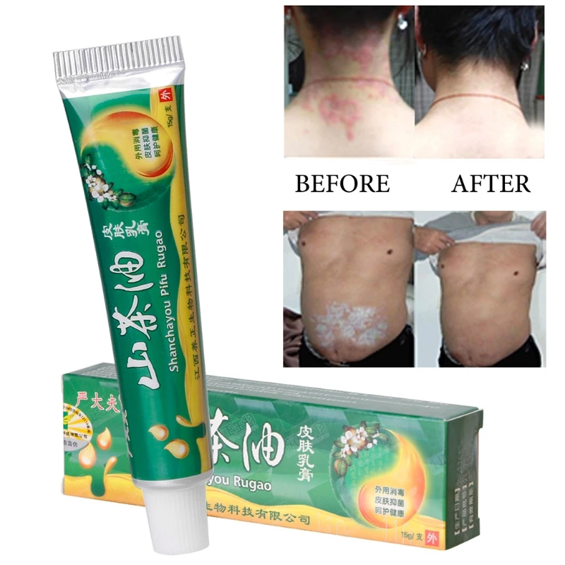15 г натуральный присущая средствам китайской медицины травяной мятный крем псориаз экзема мазь лечение высокое качество травяной крем для всех типов кожи