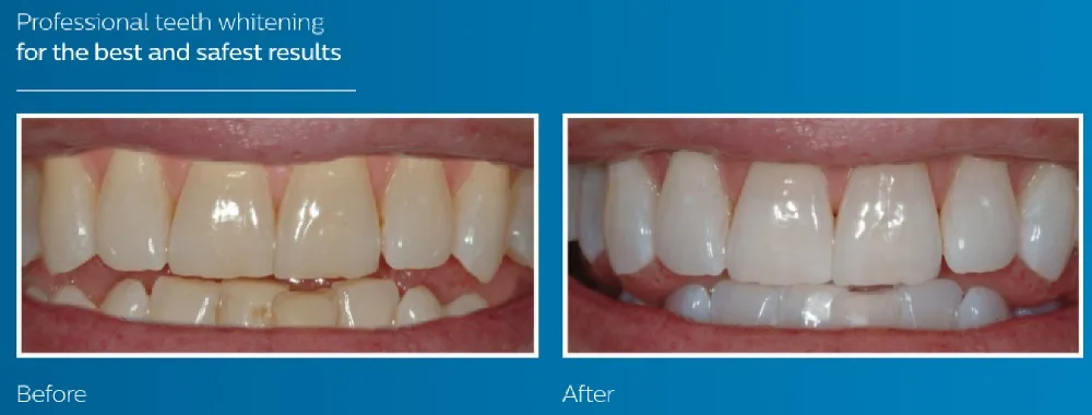 Отбеливание Зубов Zoom Купить Набор