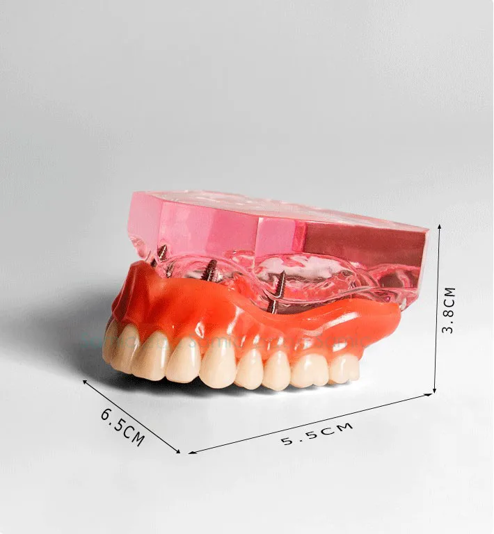 Стоматологический протез превосходный с 4 имплантатами демонстрационная модель Стоматологическое обучение исследование демонстрация модели 6001