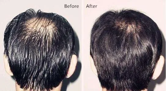 

Best quality 100ml - 500ml of 5% Purity Minoxidil Sulfate Powder Hair growth, Hair loss treatment