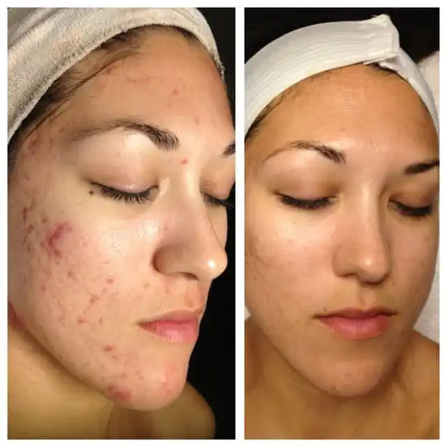 tretinoin gel for acne