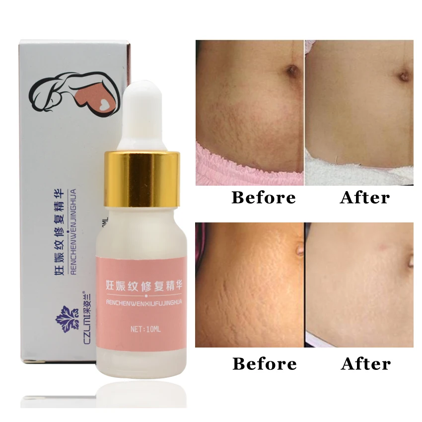 2 pcs Bio Oil Stretch Marks Maternity Essential Oil ...