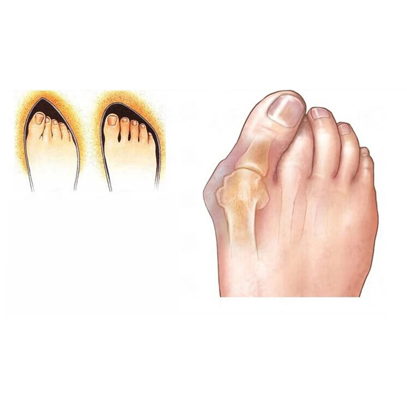 2Pcs Pedicure Concealer for Toes Gel Pedicure Stretchers Bunion Protector Straightener Bunion Corrector Foot Care Hallux Valgus