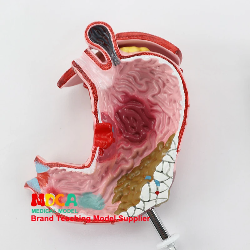 Модель обучения медицине MCW011 для человека при патологической анатомии желудка и демонстрации желудочных заболеваний