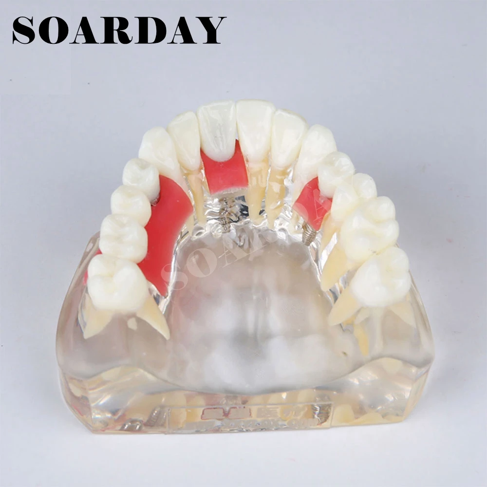 Зубная модель имплантата зубные десны Съемная демонстрационная модель