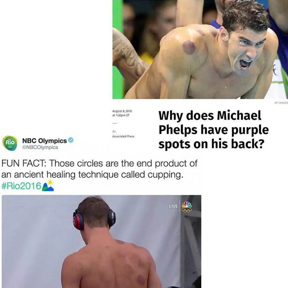 Банки для терапии 32 шт.|Лечение с помощью медицинских банок| |