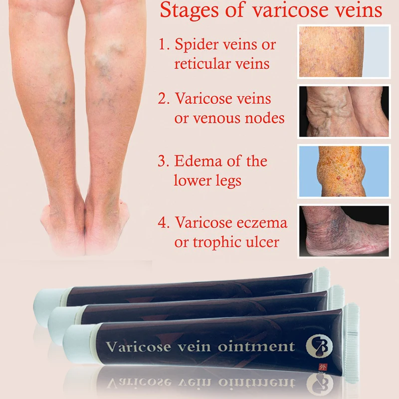 الدوالي كريم علاج فعالة علاج التهاب الأوعية وريدي العنكبوت الأوردة الألم دوالي Angiitis مرهم الرعاية الصحية