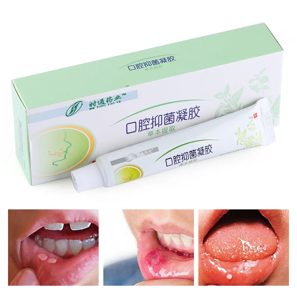 

1pc Mouth Ulcer Relief Gel Natural Herbal Oral Antibacterial Cream Fast Relief from Severe Pain & Irritation within 2 minutes