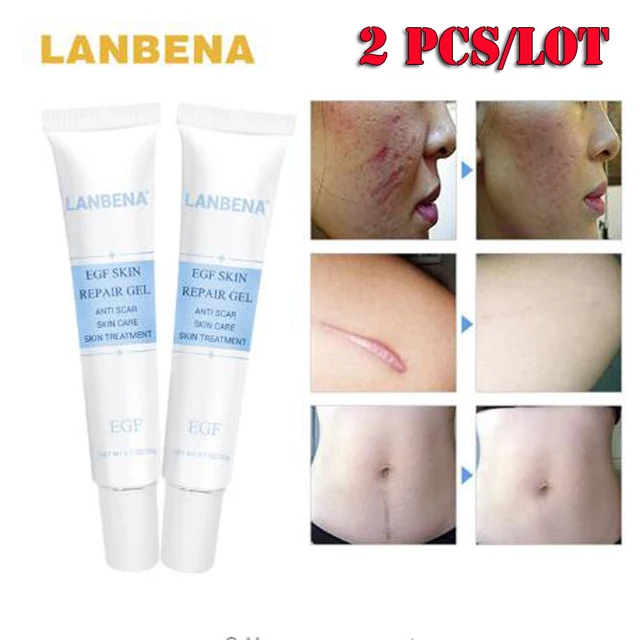 Strentch Marks Acne Scar Remover Acne Treatment Shrink Pores Gel