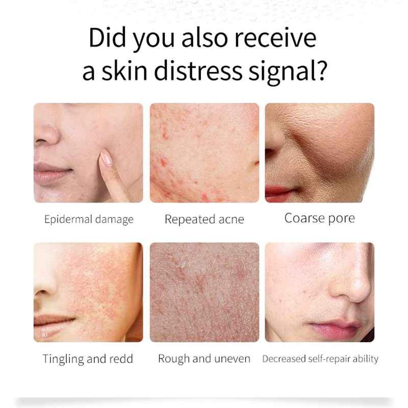 Oligopeptide Capsule 30 Piece Repair Acne Pit Acne Scar Marks Pigmentation Corrector Essential Oil Soothing Squalane Essence