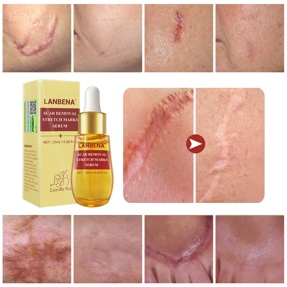 

LANBENA Hyaluronic Acid Remove Scars Essential Oil Remove Acne Essence Remove Stretch Marks Whitening Lighten Spots Skin Care
