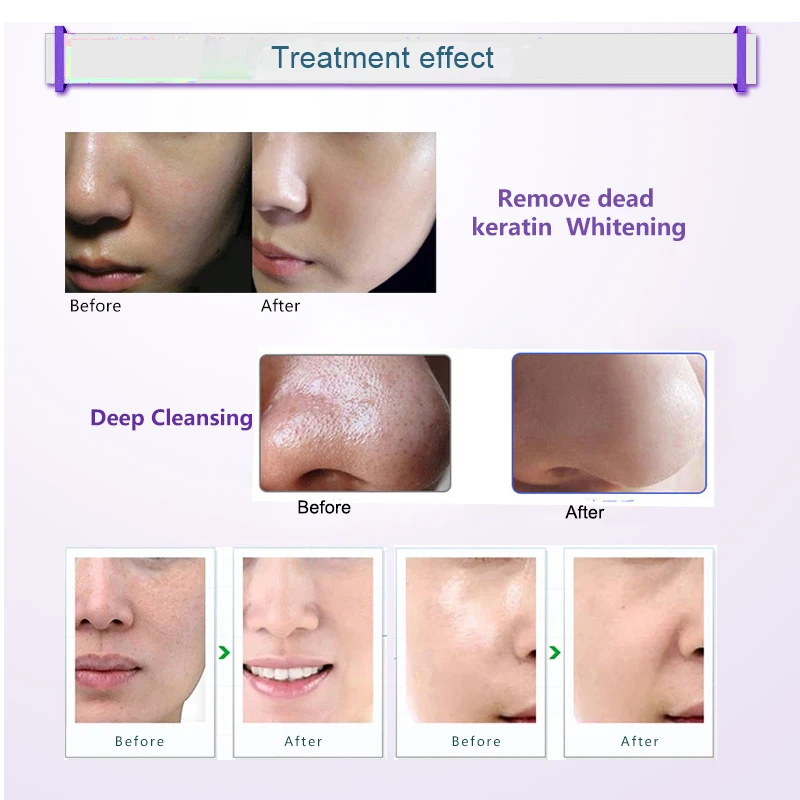 Treatmen effect