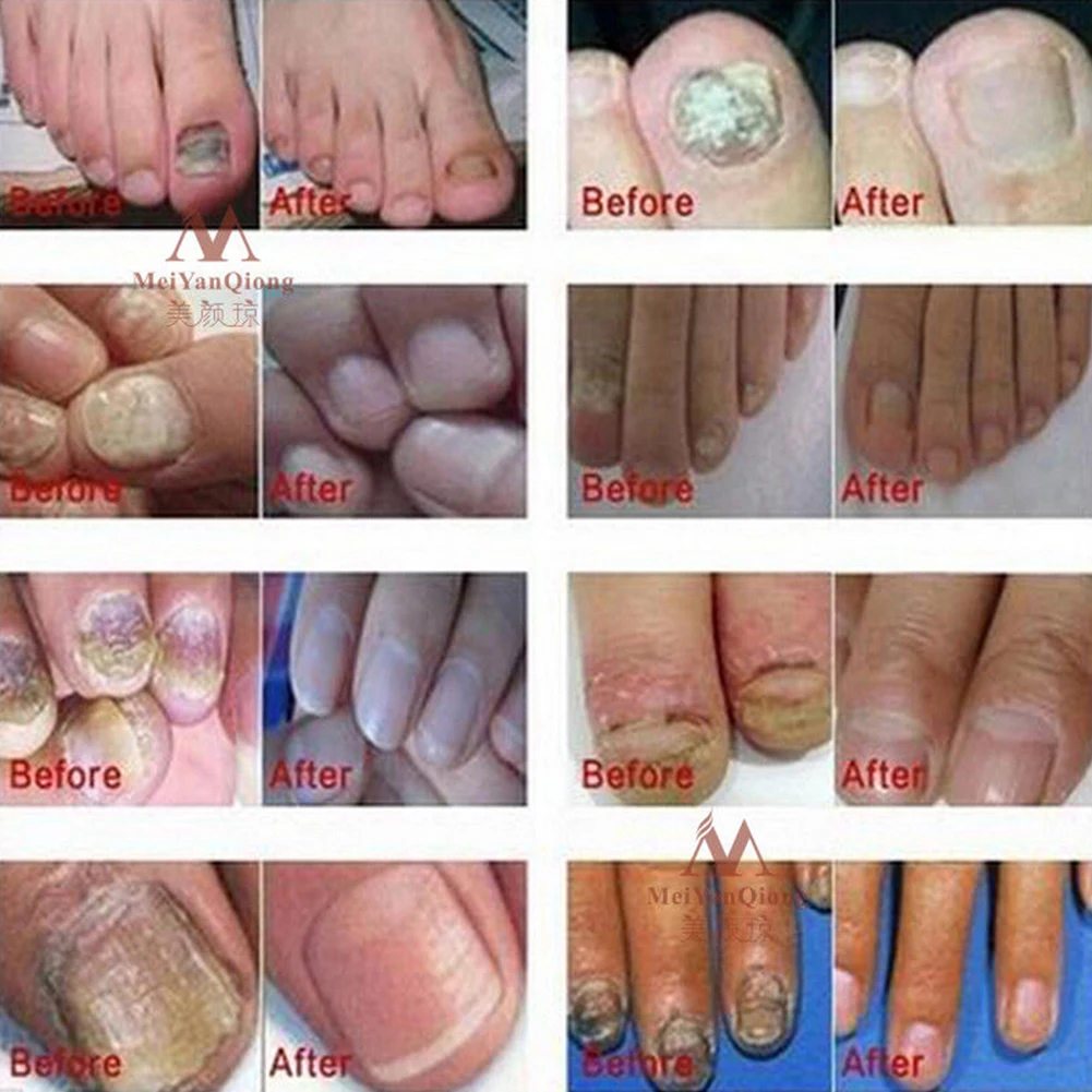 Nail Repair Cream Nourishing Herb Fingernail Care Treatment Recovery Makeup