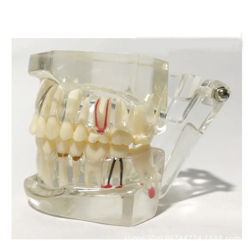 Dental Study Tooth Transparent Adult Pathological & Disease Teeth Model