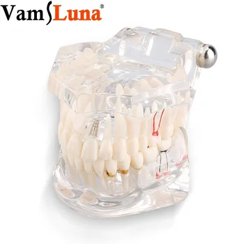 

Dental Tooth Model Transparent Adult Pathologies Study Teaching Teeth Implant Disease with Removable Tooth Restoration Bridge