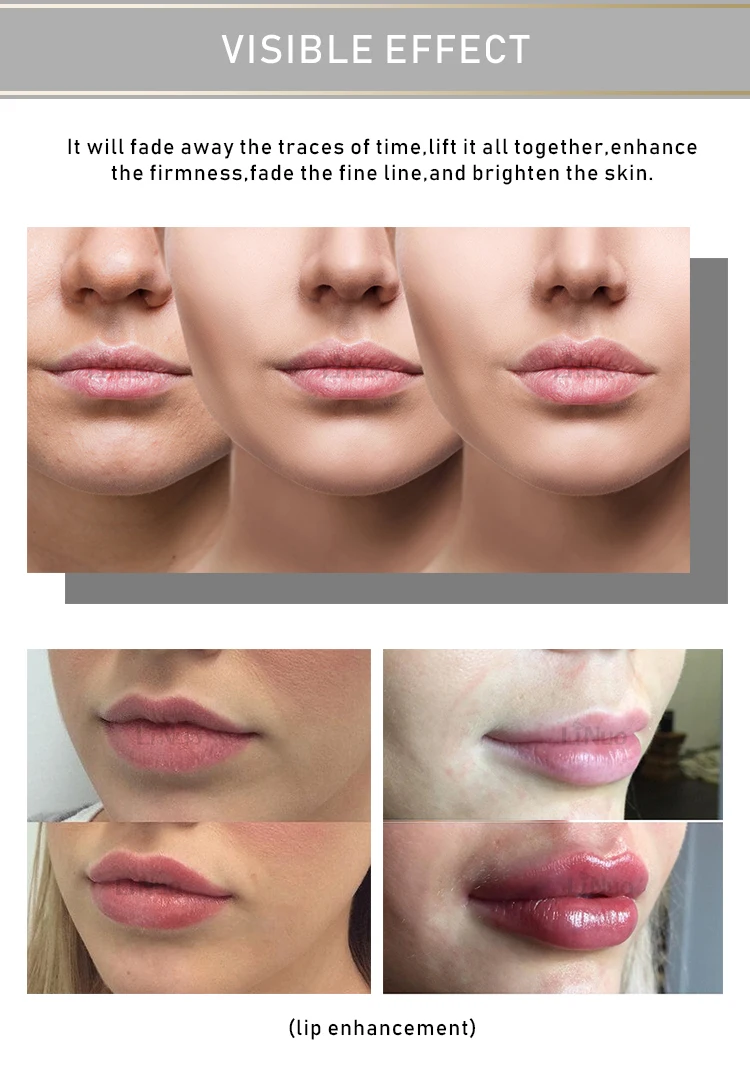 hyaluronic pen review